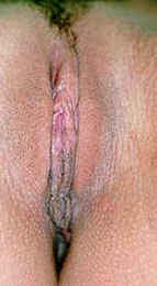 Same labia, after surgical trimming.